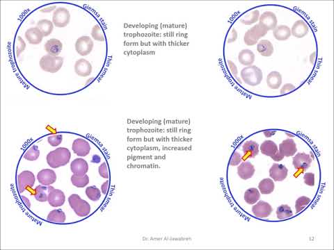 Classic illustration of Plasmodium vivax/Plasmodium falciparum coinfection  | BMJ Case Reports